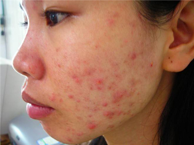 Cách trị sẹo đỏ sau mụn