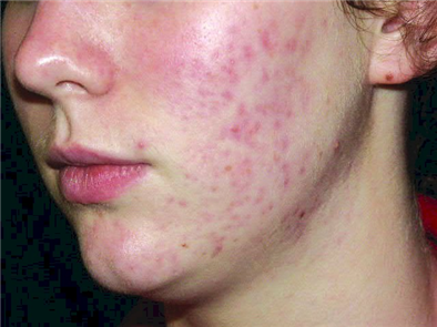 CÁC PHƯƠNG PHÁP TRỊ MỤN THÂM ĐỎ