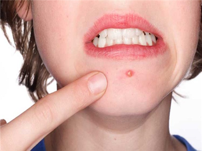 Cách trị mụn bọc đỏ nào hiệu quả từ nguyên liêu thiên nhiên