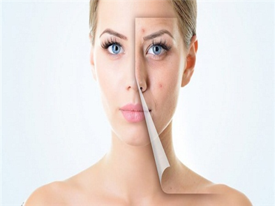 Những cach tri mun bang thien nhien nhanh nhat chị em nên bỏ túi