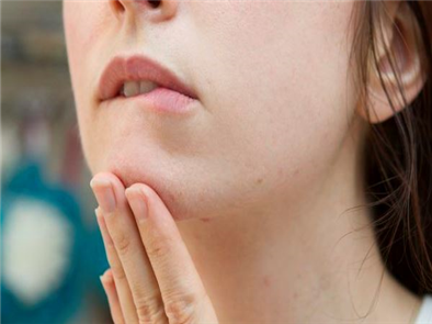 Mụn cám – Cách trị mụn cám ở mũi và cằm thế nào tốt nhất