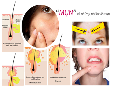 Gợi ý một số cách trị mụn cám ở tuổi dậy thì hiệu quả