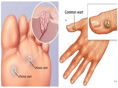 Bật mí cách trị mụn cóc nhanh nhất