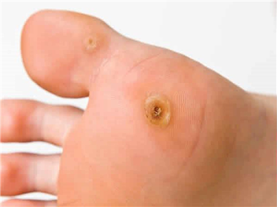 Tiết lộ cách trị mụn cóc ở chân bằng phương pháp tự nhiên