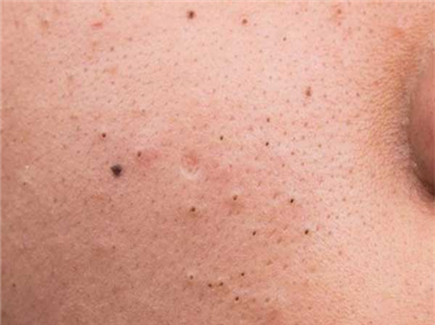 Tìm hiểu nguyên nhân và cách trị mụn đầu đen 2 bên má