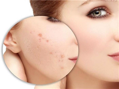 TẨY MỤN THỊT TẠI THẨM MỸ VIỆN CÓ AN TOÀN KHÔNG?