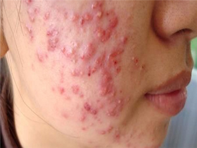Cách trị mụn bọc mụn mủ bằng nguyên liệu tự nhiên