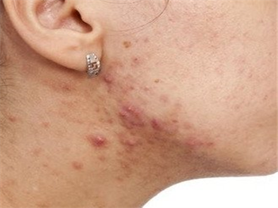 Cách trị mụn thịt ở cổ tại nhà