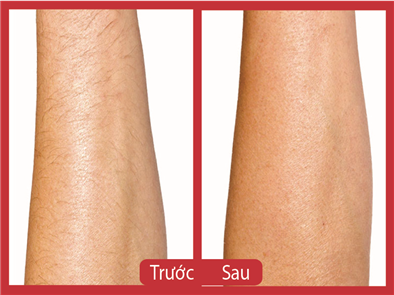 Thận trọng cách triệt lông vĩnh viễn bằng mỡ trăn