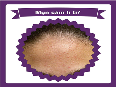 Giải đáp thắc mắc tỏi có trị được mụn không