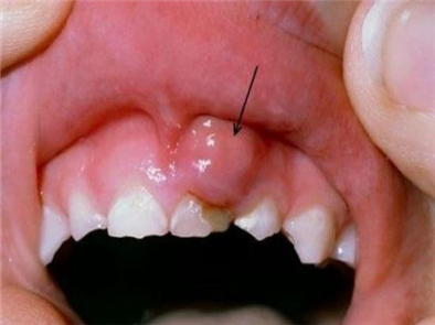 Mụn ở lợi là dấu hiệu của bệnh gì? Chữa trị ra sao?