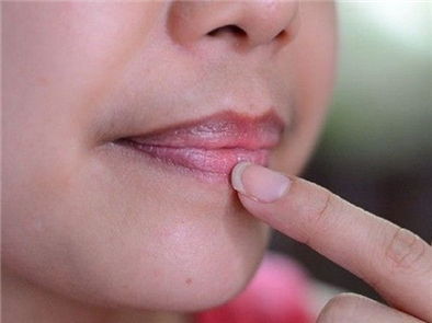 Bạn có biết môi thâm là bệnh gì và cách khắc phục như thế nào?