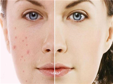 Cách trị thâm sau mụn nhanh khỏi