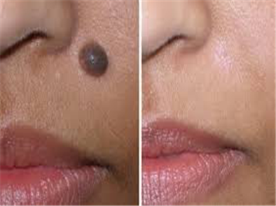 TẨY NỐT RUỒI HẾT BAO NHIÊU TIỀN- Ở ĐÂU UY TÍN ?