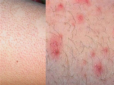 Giải đáp thắc mắc: Có nên thực hiện wax lông chân không?