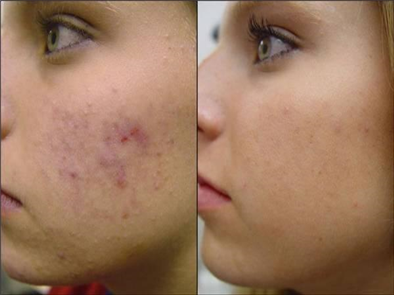 Mách bạn cách trị vết thâm sau mụn bằng nghệ tươi