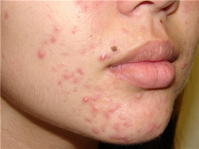 Tìm hiểu các nguyên nhân gây ra mụn bọc