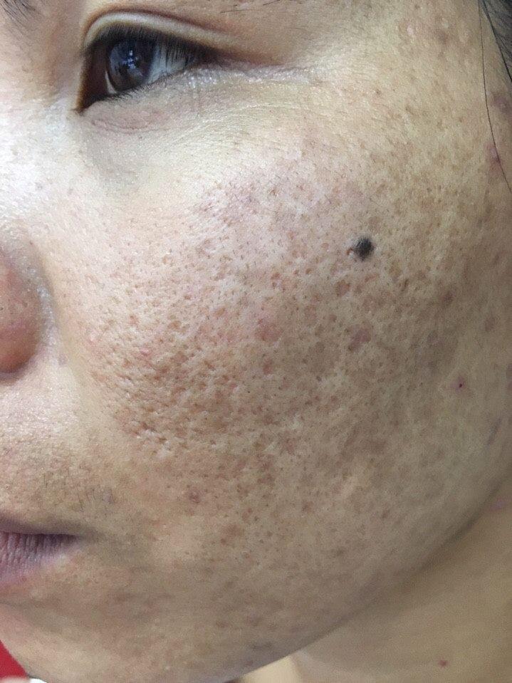 ban-co-biet-cach-lam-mat-na-tri-vet-tham-mun-hieu-qua-nhat
