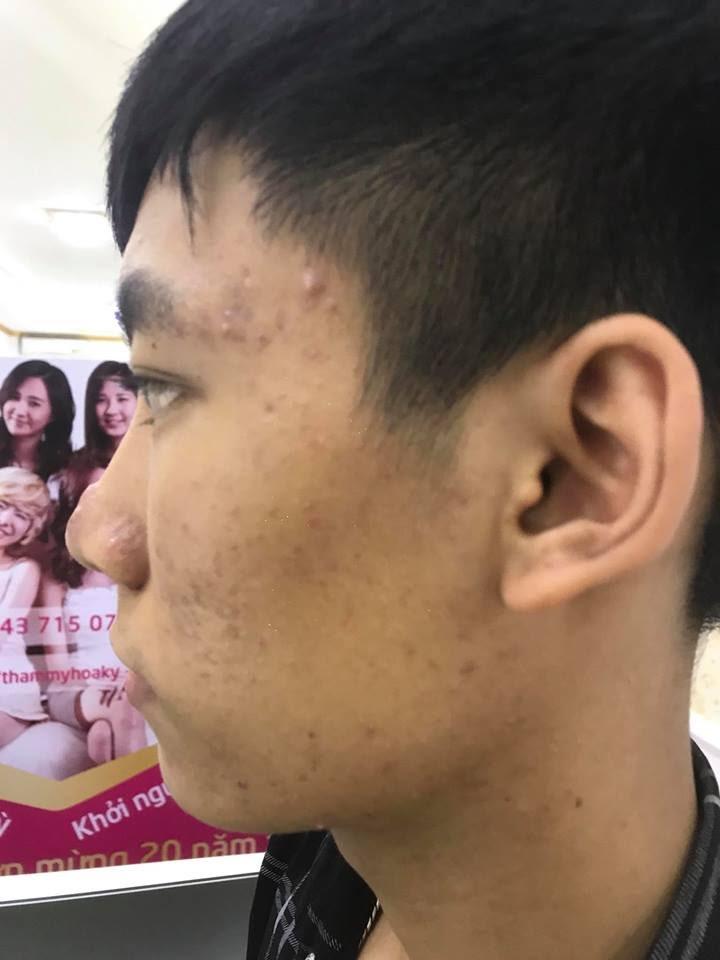 ban-co-biet-cach-lam-mat-na-tri-vet-tham-mun-hieu-qua-nhat