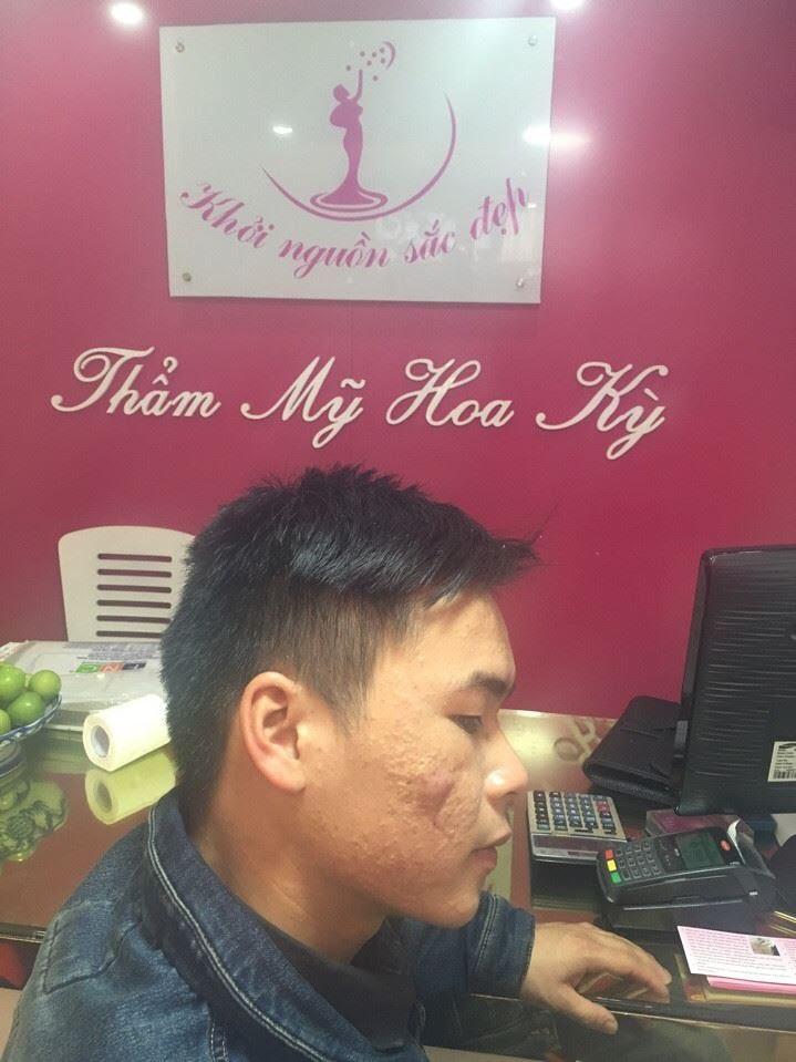 ban-co-biet-cach-lam-mat-na-tri-vet-tham-mun-hieu-qua-nhat