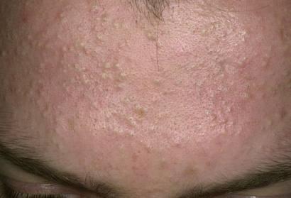 Bật mí cách trị mụn ẩn dưới da hiệu quả nhất