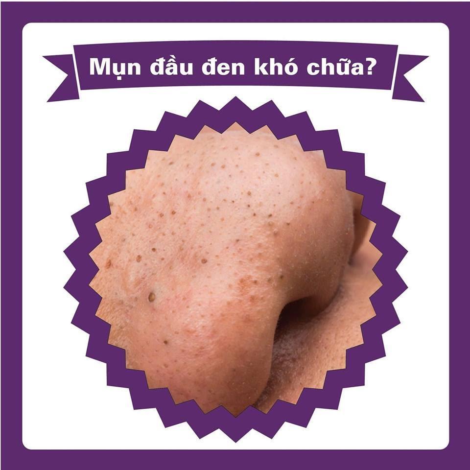 /cach-chua-mun-dau-den-o-mui-cac-gai-nen-biet