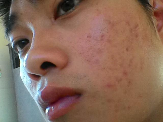 mach-ban-cach-tri-vet-tham-sau-mun-bang-nghe-tuoi