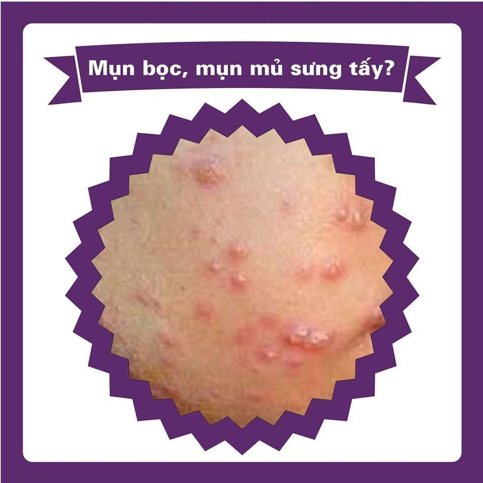 NGUYÊN NHÂN GÂY RA MỤN BỌC BẠN ĐÃ BIẾT CHƯA