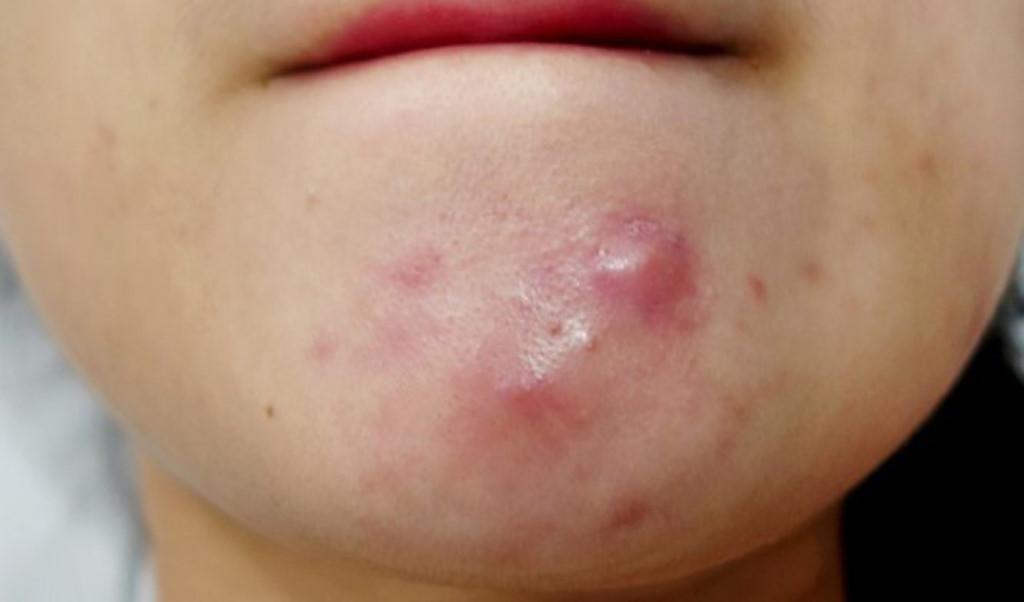 NGUYÊN NHÂN GÂY RA MỤN BỌC BẠN ĐÃ BIẾT CHƯA
