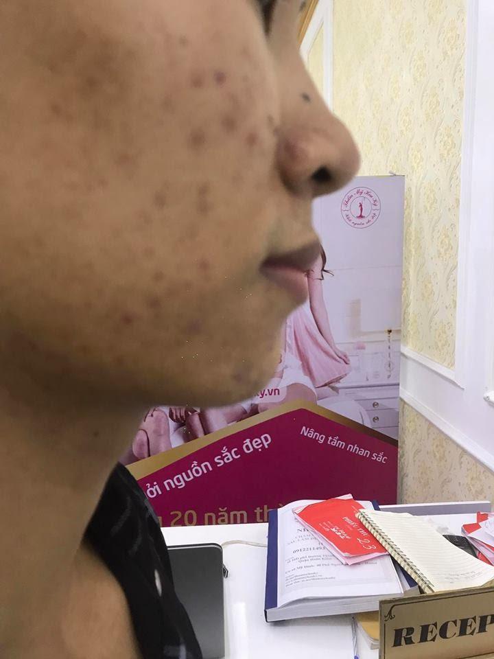 NGUYÊN NHÂN GÂY RA MỤN BỌC BẠN ĐÃ BIẾT CHƯA