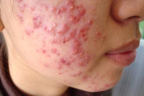 TÌM HIỂU CÁC NGUYÊN NHÂN GÂY RA MỤN BỌC