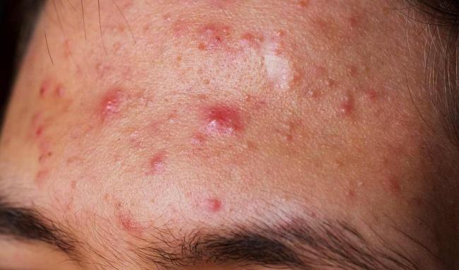 nguyên nhân gây ra mụn bọc