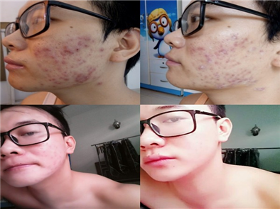 Một số cách trị mụn thâm đen cho nam giới bằng nha đam