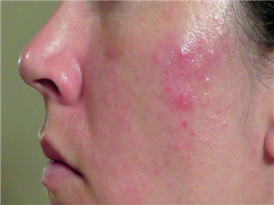 Các tiêu chí lựa chọn bệnh viện da liễu trị mụn uy tín